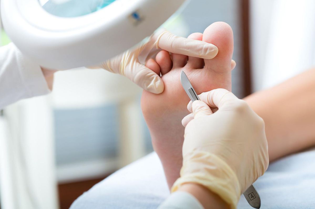 Tratamiento de Hongos y Callos en Bogotá - Pie Pro Salud Kennedy