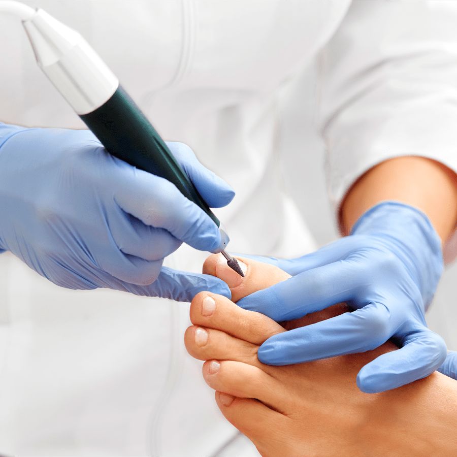 Tratamiento de Uña Encarnada en Bogotá - Pie Pro Salud Kennedy